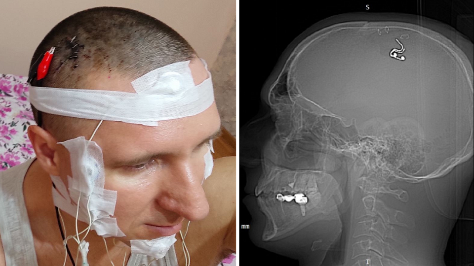 «Я готов был умереть»: уроженец Академгородка сам себе провёл операцию на мозге