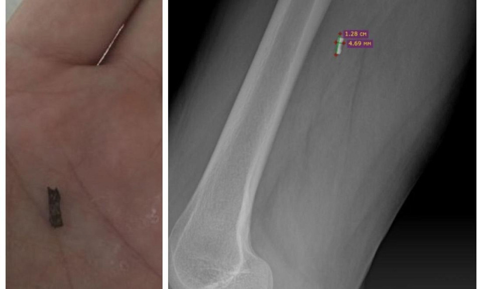 Хирурги ННИИТО удалили опасный осколок из ноги пациента
