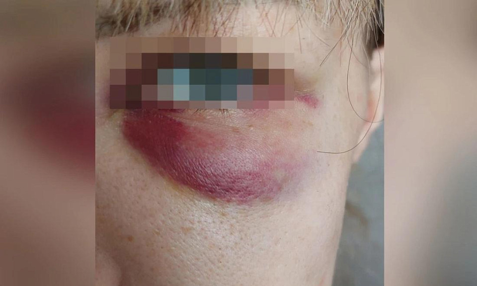 Перелом носа, опухоль и синяк: трое парней избили девушку в Новосибирске