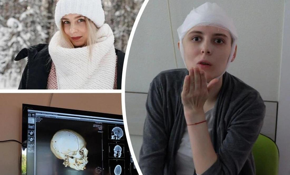 Имплант вместо части черепа установили девушке после падения на самокате